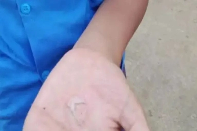 হাতে গরম তেল ঢেলে শাস্তি, দগ্ধ ২৫ শিক্ষার্থী
